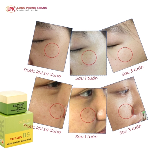 OLY HT Luxury Vitamin B5 Kem Nám Tàn Nhang Đồi Mồi 25g OLY HT Luxury Vitamin B5 Kem Nám Tàn Nhang Đồi Mồi 25g
